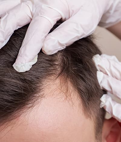 Hair loss treatment